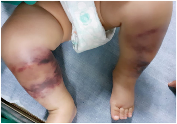 Multiple well-defined irregular purpuric macules with areas of blackish discolouration over both legs (Day 1 of presentation – at 10 months of age).